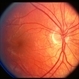 Inferior conus of optic nerve with neurofibromatosis Inferior conus of optic nerve with neurofibromatosis