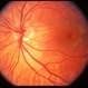 Inferior conus of optic nerve with neurofibromatosis Inferior conus of optic nerve with neurofibromatosis