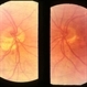 Inferior conus of optic nerve Inferior conus of optic nerve