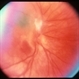 Unknown – Peripapillary and macular scar Unknown – Peripapillary and macular scar