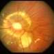 Optic Nerve Malformation / Coloboma Optic Nerve Malformation / Coloboma