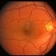 Leber's Stellate Maculopathy / Central Serous Retinopathy Leber's Stellate Maculopathy / Central Serous Retinopathy