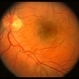 Leber's Stellate Maculopathy / Central Serous Retinopathy Leber's Stellate Maculopathy / Central Serous Retinopathy
