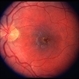 Leber's Stellate Maculopathy / Central Serous Retinopathy Leber's Stellate Maculopathy / Central Serous Retinopathy