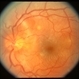Leber's Stellate Maculopathy / Central Serous Retinopathy Leber's Stellate Maculopathy / Central Serous Retinopathy