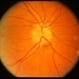 Disc Drusen With Subretinal Hemorrhage Without Subretinal New Vessel Membrane Disc Drusen With Subretinal Hemorrhage Without Subretinal New Vessel Membrane