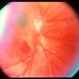 Unknown – Peripapillary and macular scar Unknown – Peripapillary and macular scar