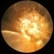 Morning Glory Optic Nerve Malformation With Retinal Detachment Morning Glory Optic Nerve Malformation With Retinal Detachment