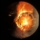 Morning Glory Optic Nerve Malformation / Perhaps Associated With Drusen / Old Resolved Retinal Detachment With Pigmentation Morning Glory Optic Nerve Malformation / Perhaps Associated With Drusen / Old Resolved Retinal Detachment With Pigmentation