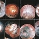 Morning Glory Optic Nerve Malformation Collage Morning Glory Optic Nerve Malformation Collage