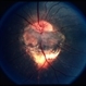 Optic Nerve Malformation / Coloboma Optic Nerve Malformation / Coloboma