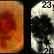 Venous Loop on the Optic Nerve With Subretinal and Vitreous Hemorrhage Venous Loop on the Optic Nerve With Subretinal and Vitreous Hemorrhage