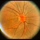 Venous Loop on the Optic Nerve With Subretinal and Vitreous Hemorrhage Venous Loop on the Optic Nerve With Subretinal and Vitreous Hemorrhage