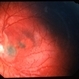 Unknown – Peripapillary and macular scar Unknown – Peripapillary and macular scar