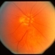 Optic Nerve Hypoplasia Optic Nerve Hypoplasia