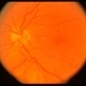 Optic Nerve Hypoplasia