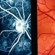 Optic  Nerve Head Drusen Optic  Nerve Head Drusen