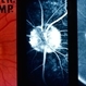 Optic Nerve Head Drusen Optic Nerve Head Drusen