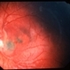 Unknown – Peripapillary and macular scar Unknown – Peripapillary and macular scar