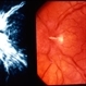 Optic Nerve Congestion / Venous Stasis Optic Nerve Congestion / Venous Stasis
