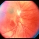 Unknown – Peripapillary and macular scar Unknown – Peripapillary and macular scar
