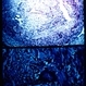Pathology Slide of Giant Cell Arteritis Pathology Slide of Giant Cell Arteritis