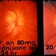 Giant Cell Arteritis With Ischemic Optic Nerve