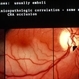 Inferior Hemisphere Artery Occlusion Inferior Hemisphere Artery Occlusion