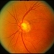 Optic Pit With Old Resolved Subretinal Fluid Optic Pit With Old Resolved Subretinal Fluid