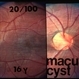 Optic Pit With Subretinal Fluid and Macular Cyst Optic Pit With Subretinal Fluid and Macular Cyst