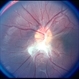 Combined  Hamartoma Combined  Hamartoma