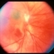 Unknown – Peripapillary and macular scar Unknown – Peripapillary and macular scar