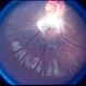 Combined  Hamartoma Combined  Hamartoma