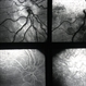 Optic Nerve Drusen Optic Nerve Drusen