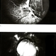 Optic Nerve Coloboma / Morning Glory Optic Nerve Coloboma / Morning Glory