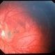 Unknown – Peripapillary and macular scar Unknown – Peripapillary and macular scar