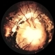 Optic Nerve Coloboma / Morning Glory Syndrome / Retinal Detachment Optic Nerve Coloboma / Morning Glory Syndrome / Retinal Detachment