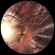 Optic Nerve Coloboma / Morning Glory Syndrome / Retinal Detachment Optic Nerve Coloboma / Morning Glory Syndrome / Retinal Detachment
