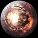 Optic Nerve Coloboma / Morning Glory Syndrome / Retinal Detachment Optic Nerve Coloboma / Morning Glory Syndrome / Retinal Detachment