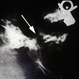 Optic Nerve Coloboma / Morning Glory Syndrome / Encephalocele Optic Nerve Coloboma / Morning Glory Syndrome / Encephalocele