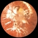 Optic Nerve Coloboma / Morning Glory Syndrome / Encephalocele / X-Ray Optic Nerve Coloboma / Morning Glory Syndrome / Encephalocele / X-Ray