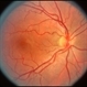 Disc Hypoplasia