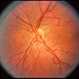 Disc Hypoplasia Disc Hypoplasia