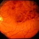 Terson's Syndrome Terson's Syndrome