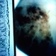 Terson's Syndrome Terson's Syndrome