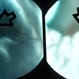Retinal Detachment Retinal Detachment