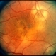Retinal Detachment Retinal Detachment