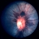 Terson's Syndrome / Pseudotumor Cerebri Terson's Syndrome / Pseudotumor Cerebri