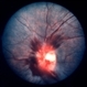 Terson's Syndrome / Pseudotumor Cerebri Terson's Syndrome / Pseudotumor Cerebri
