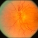 Infiltrative Cancer of the Optic Nerve